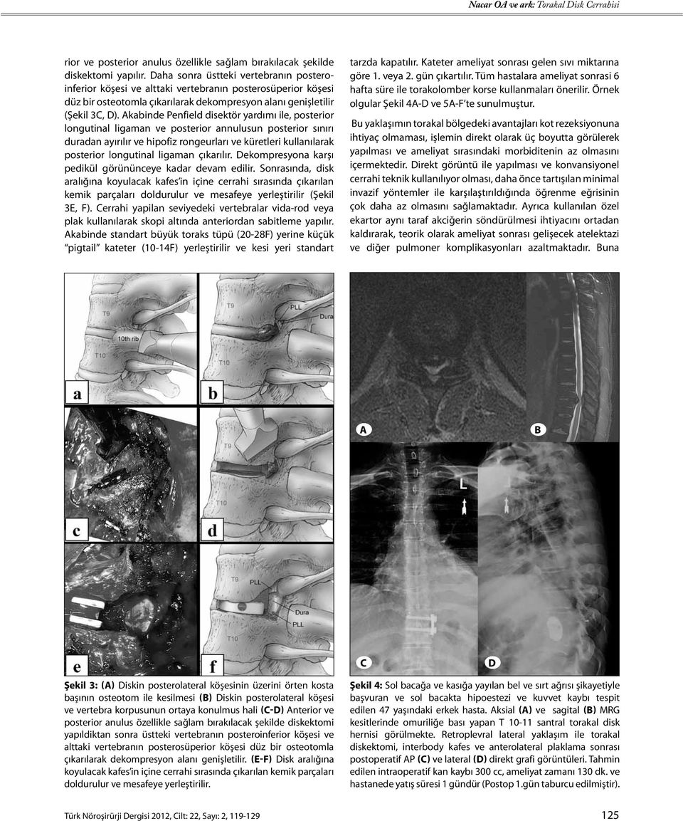 Akabinde Penfield disektör yardımı ile, posterior longutinal ligaman ve posterior annulusun posterior sınırı duradan ayırılır ve hipofiz rongeurları ve küretleri kullanılarak posterior longutinal