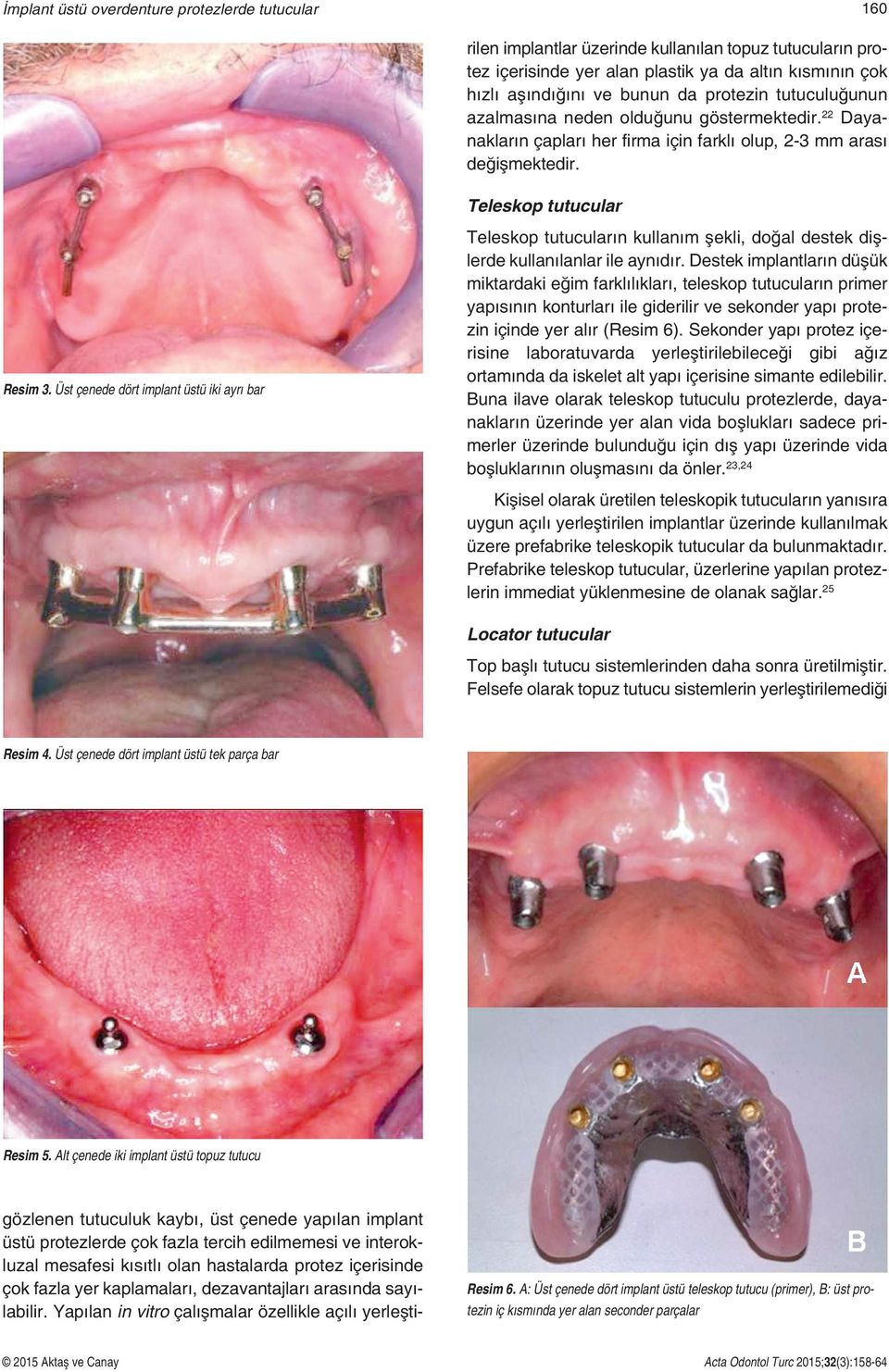 Üst çenede dört implant üstü iki ayrı bar Teleskop tutucuların kullanım şekli, doğal destek dişlerde kullanılanlar ile aynıdır.