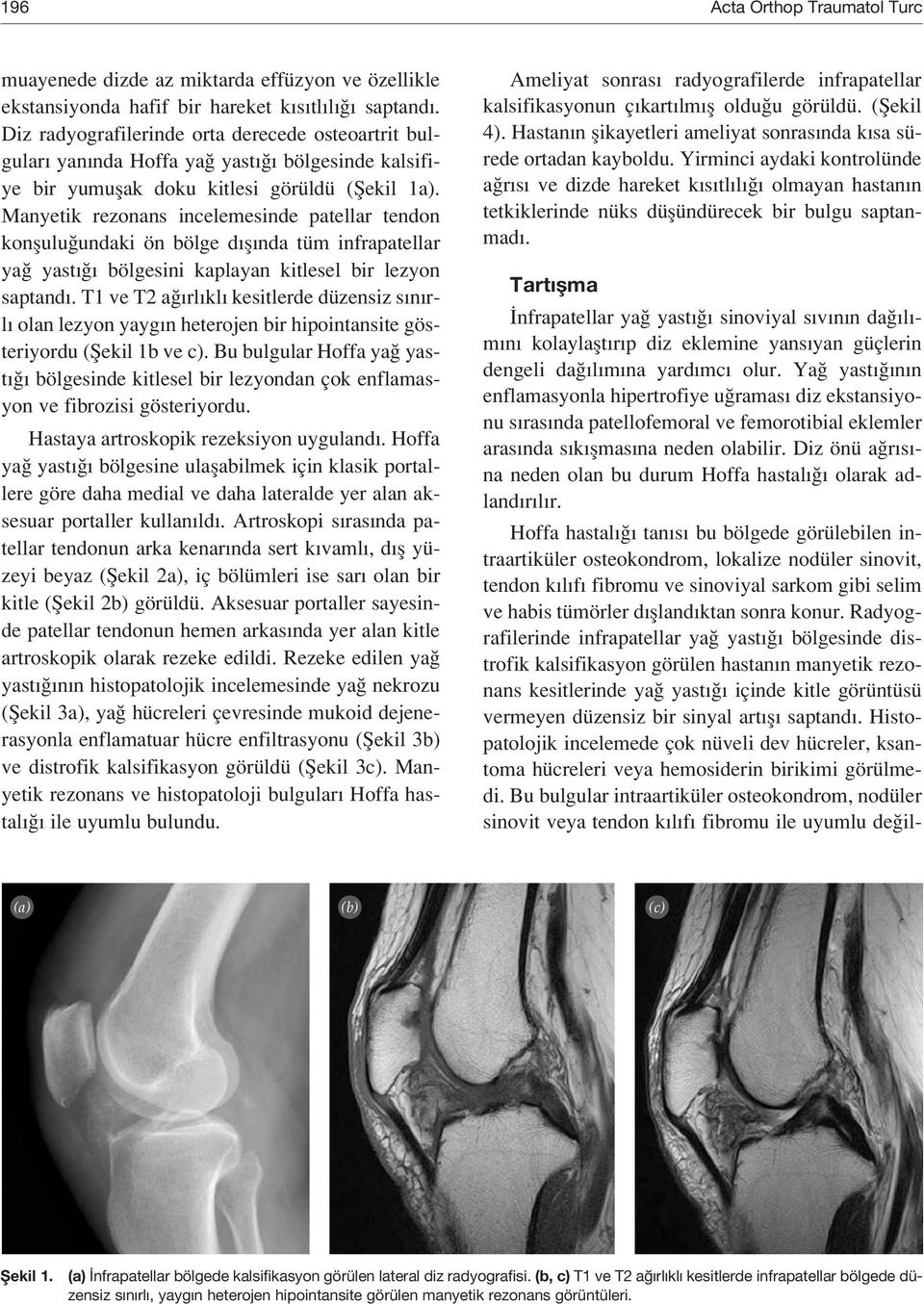 Manyetik rezonans incelemesinde patellar tendon konflulu undaki ön bölge d fl nda tüm infrapatellar ya yast bölgesini kaplayan kitlesel bir lezyon saptand.