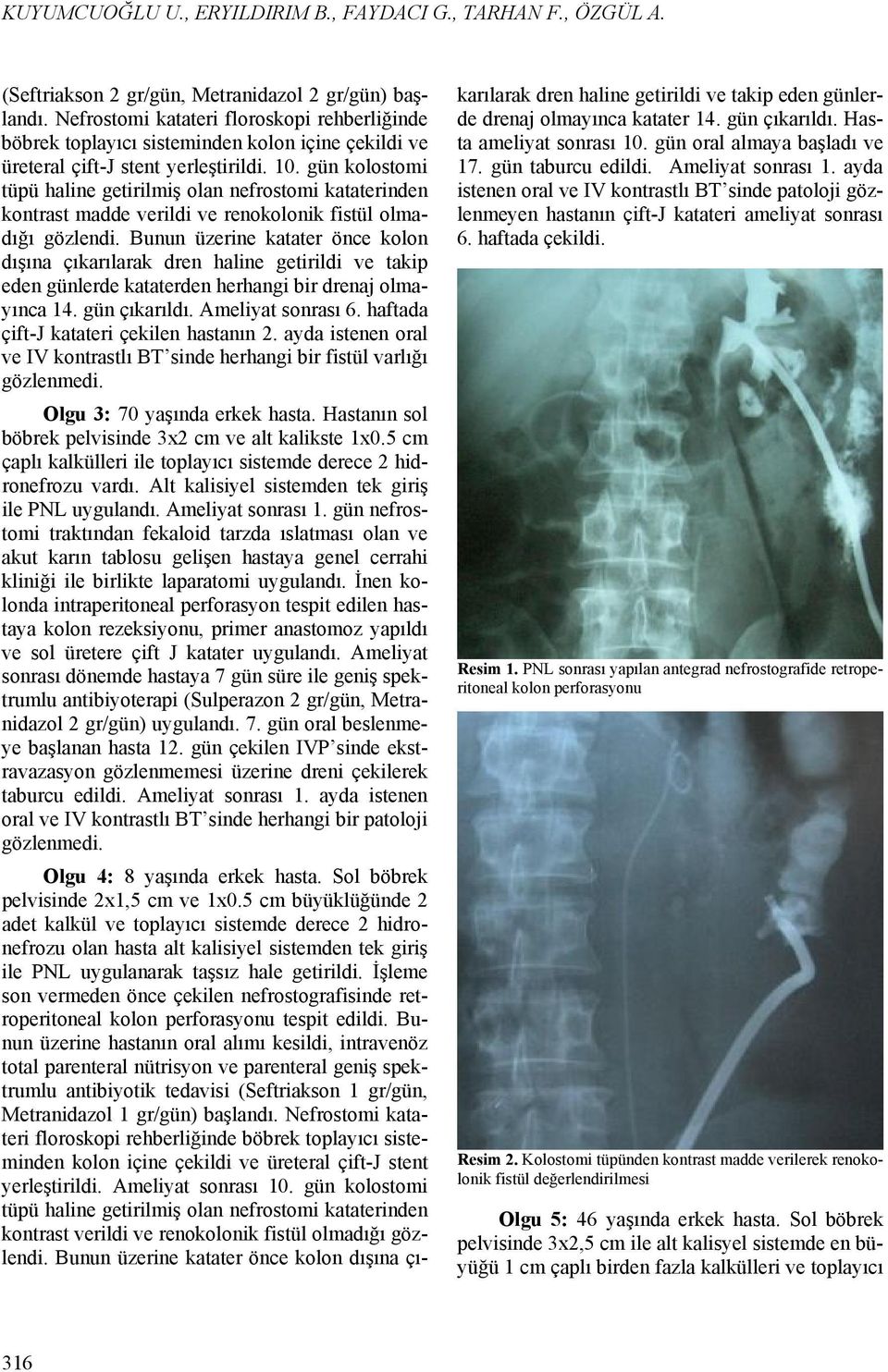 gün kolostomi tüpü haline getirilmiş olan nefrostomi kataterinden kontrast madde verildi ve renokolonik fistül olmadığı gözlendi.