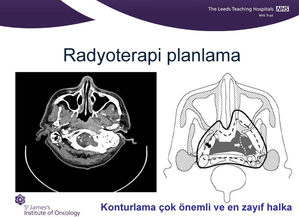 Konturlama çok