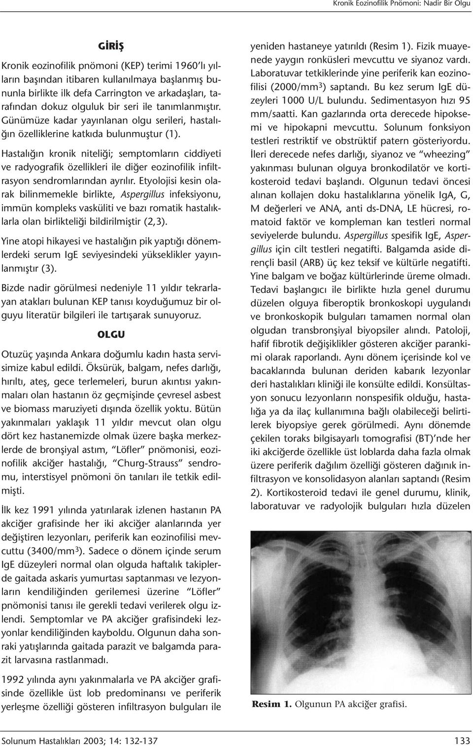 Hastalığın kronik niteliği; semptomların ciddiyeti ve radyografik özellikleri ile diğer eozinofilik infiltrasyon sendromlarından ayrılır.