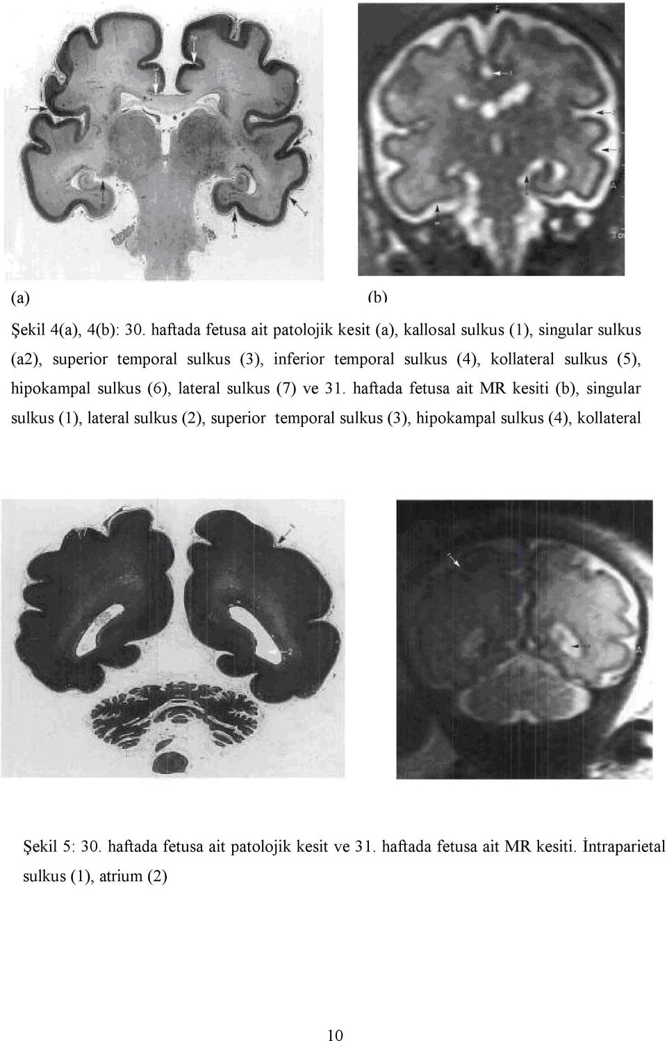 temporal sulkus (4), kollateral sulkus (5), hipokampal sulkus (6), lateral sulkus (7) ve 31.