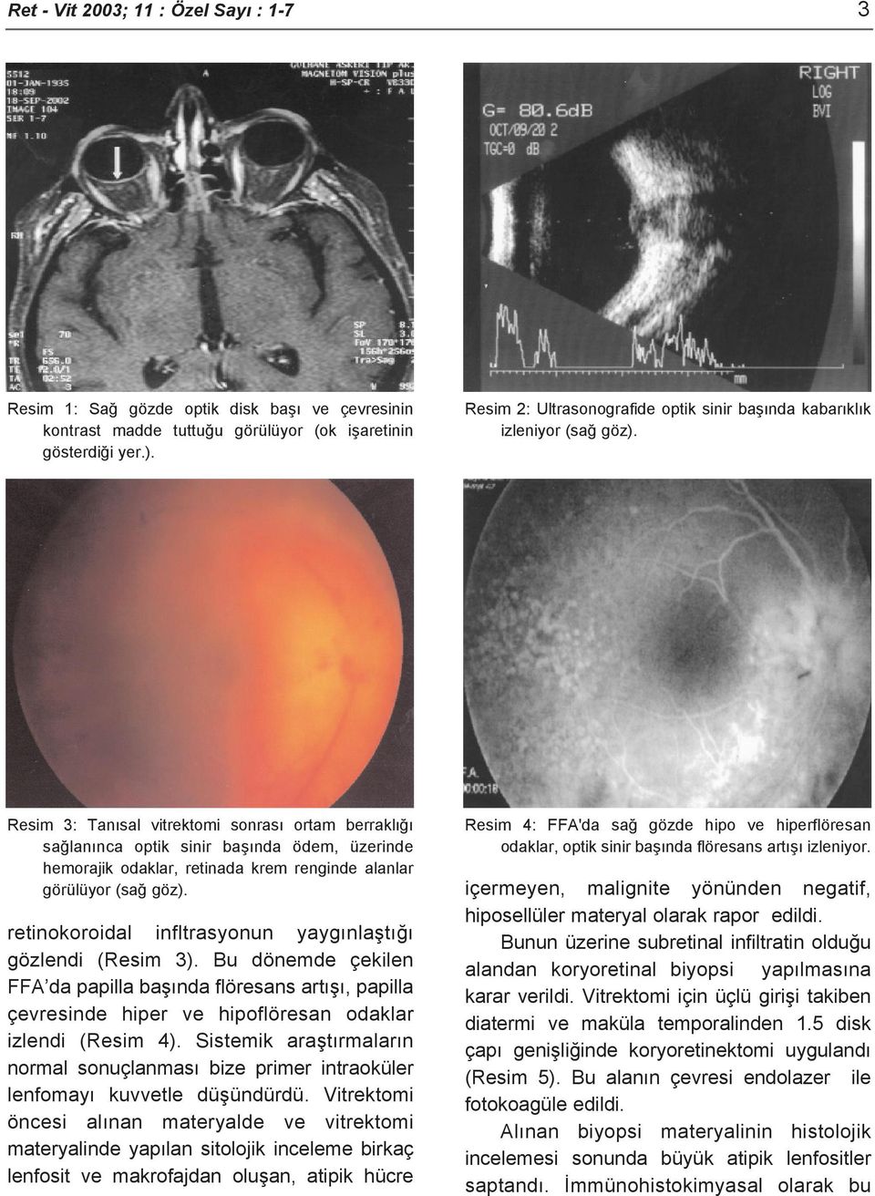 Resim 3: Tanısal vitrektomi sonrası ortam berraklığı sağlanınca optik sinir başında ödem, üzerinde hemorajik odaklar, retinada krem renginde alanlar görülüyor (sağ göz).
