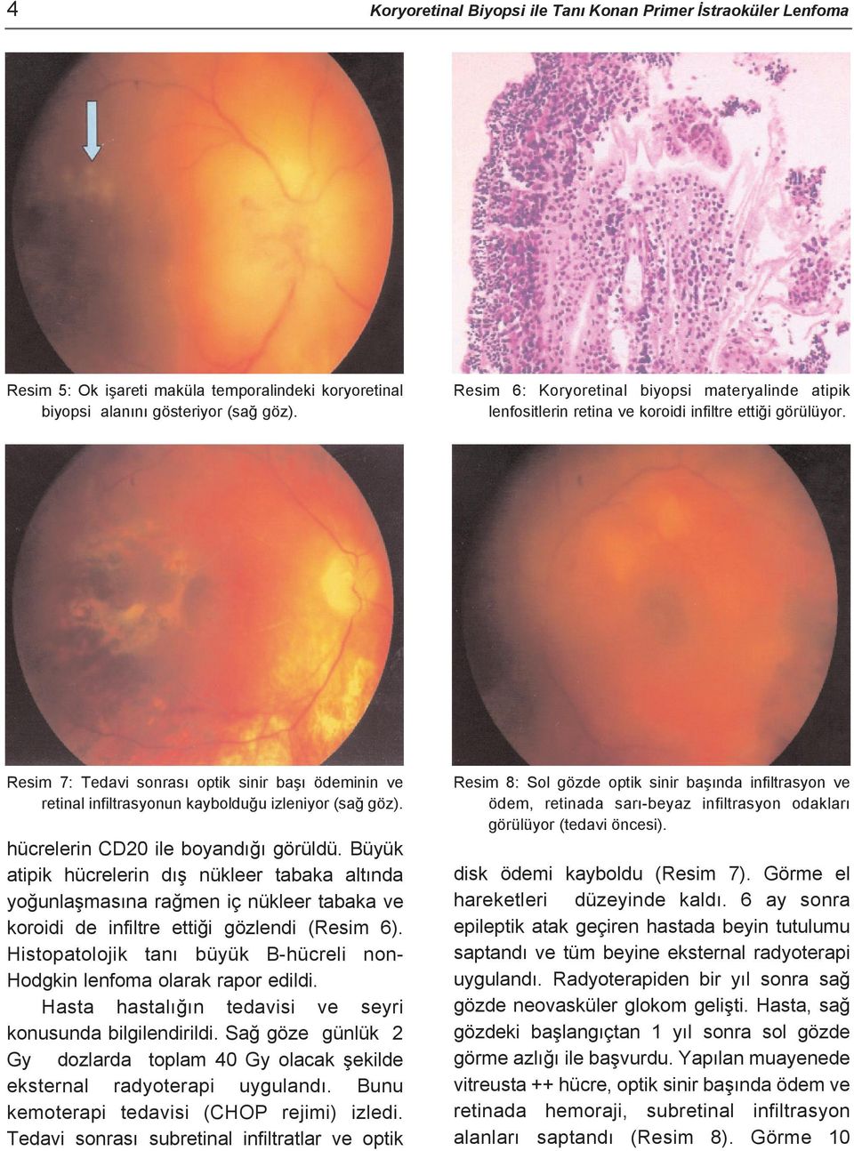 Resim 7: Tedavi sonrası optik sinir başı ödeminin ve retinal infiltrasyonun kaybolduğu izleniyor (sağ göz). hücrelerin CD20 ile boyandığı görüldü.