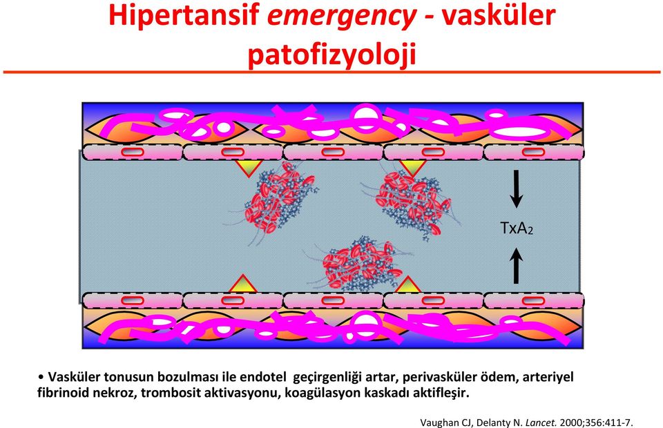 ödem, arteriyel fibrinoid nekroz, trombosit aktivasyonu,