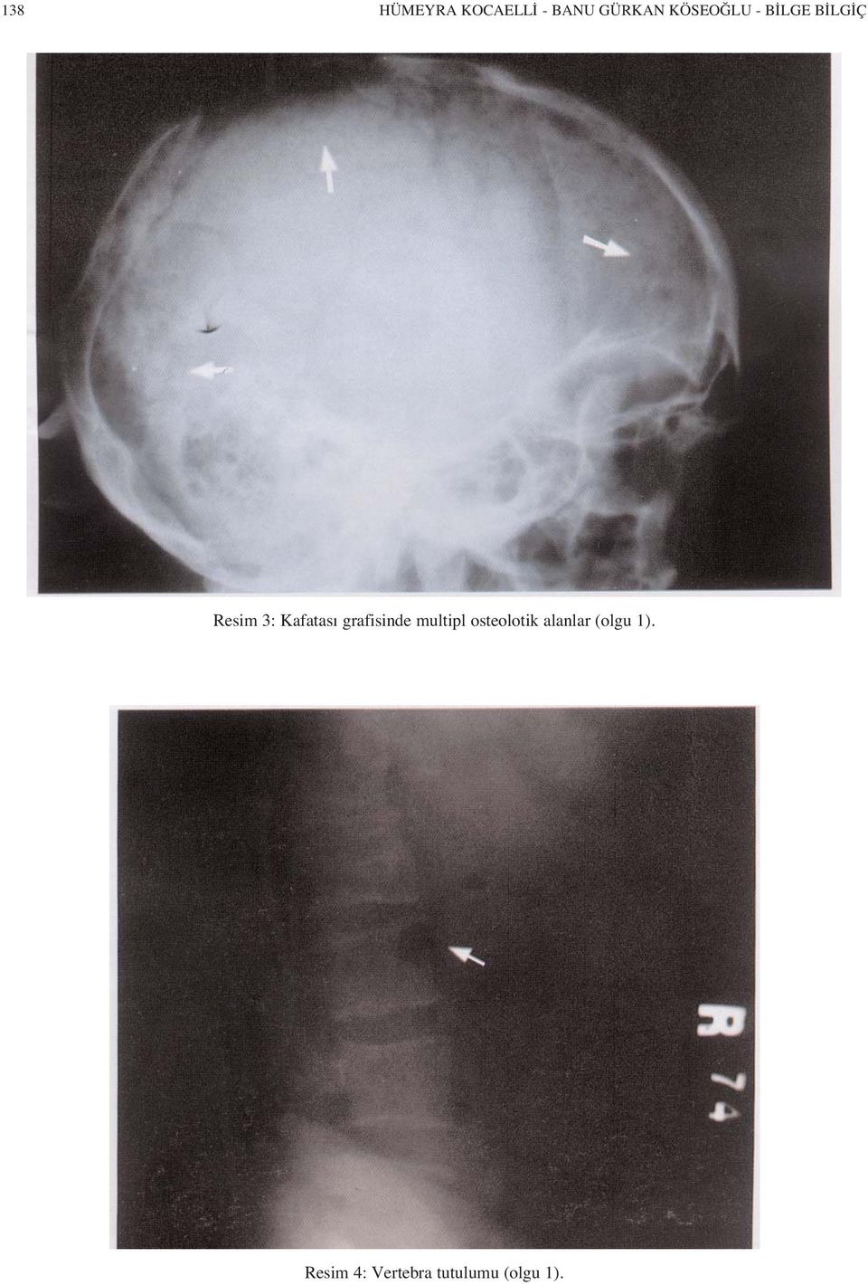 Kafatas grafisinde multipl osteolotik