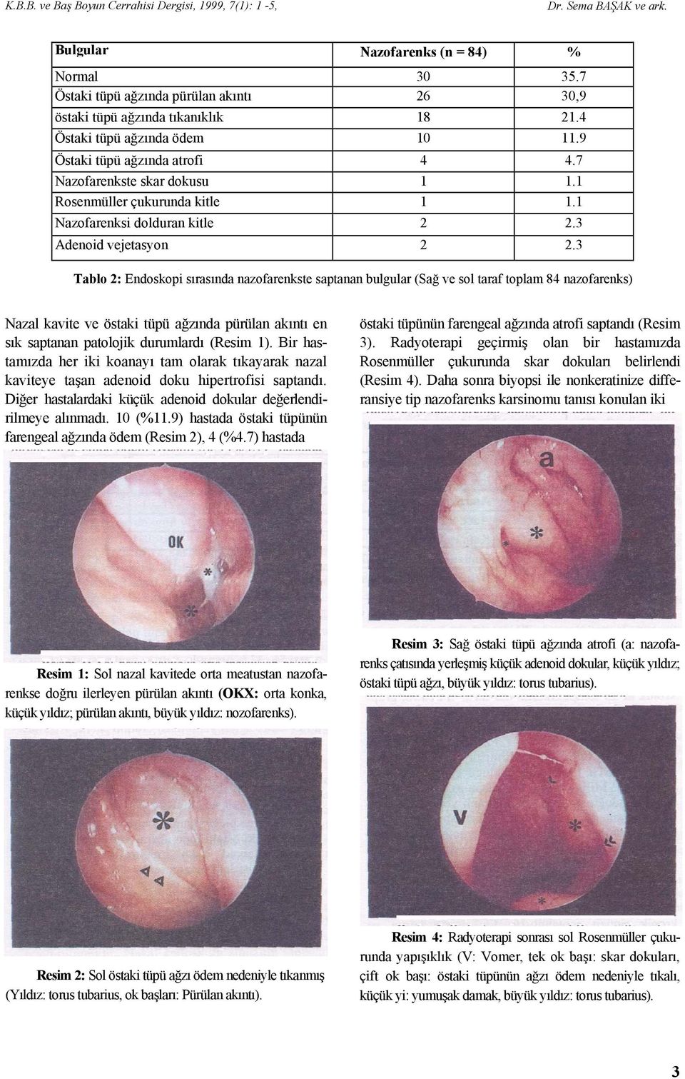 3 Tablo 2: Endoskopi sırasında nazofarenkste saptanan bulgular (Sağ ve sol taraf toplam 84 nazofarenks) Nazal kavite ve östaki tüpü ağzında pürülan akıntı en sık saptanan patolojik durumlardı (Resim