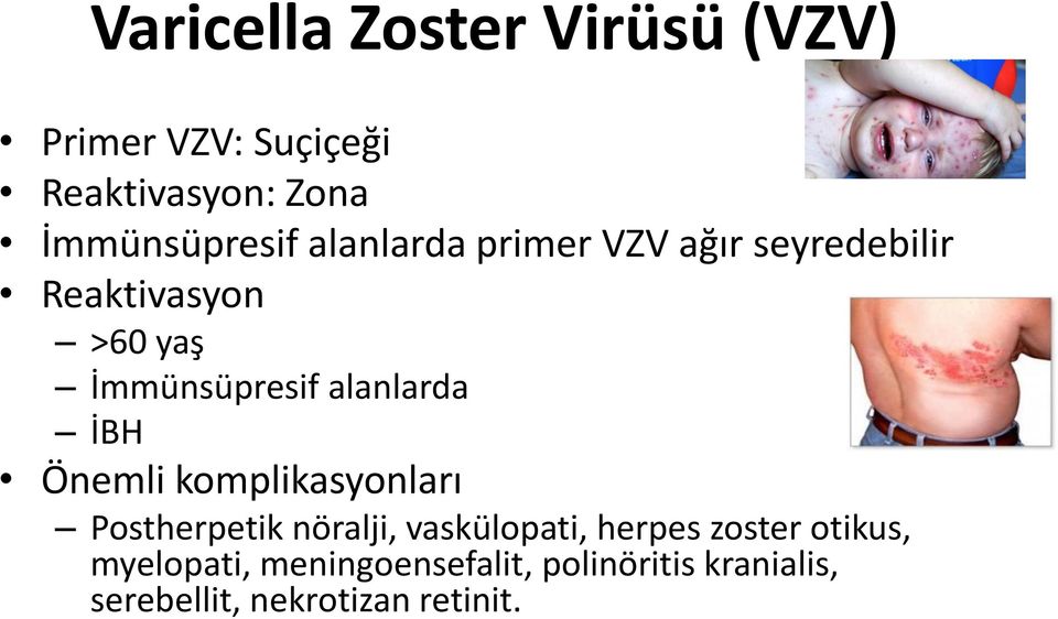 İBH Önemli komplikasyonları Postherpetik nöralji, vaskülopati, herpes zoster