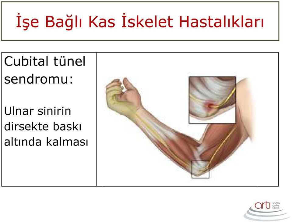 tünel sendromu: Ulnar