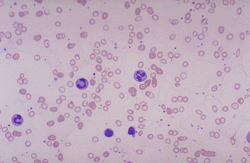 Ferritin Hb elektroforezi, anormal Hb