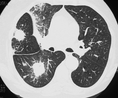 Radyolojik bulgular Yamalı konsolidasyon Çoklu kavite Çoklu