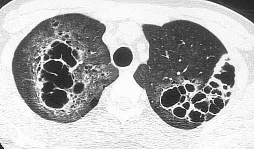 Küçük kistler Üst/Santral akciğer alanlarında