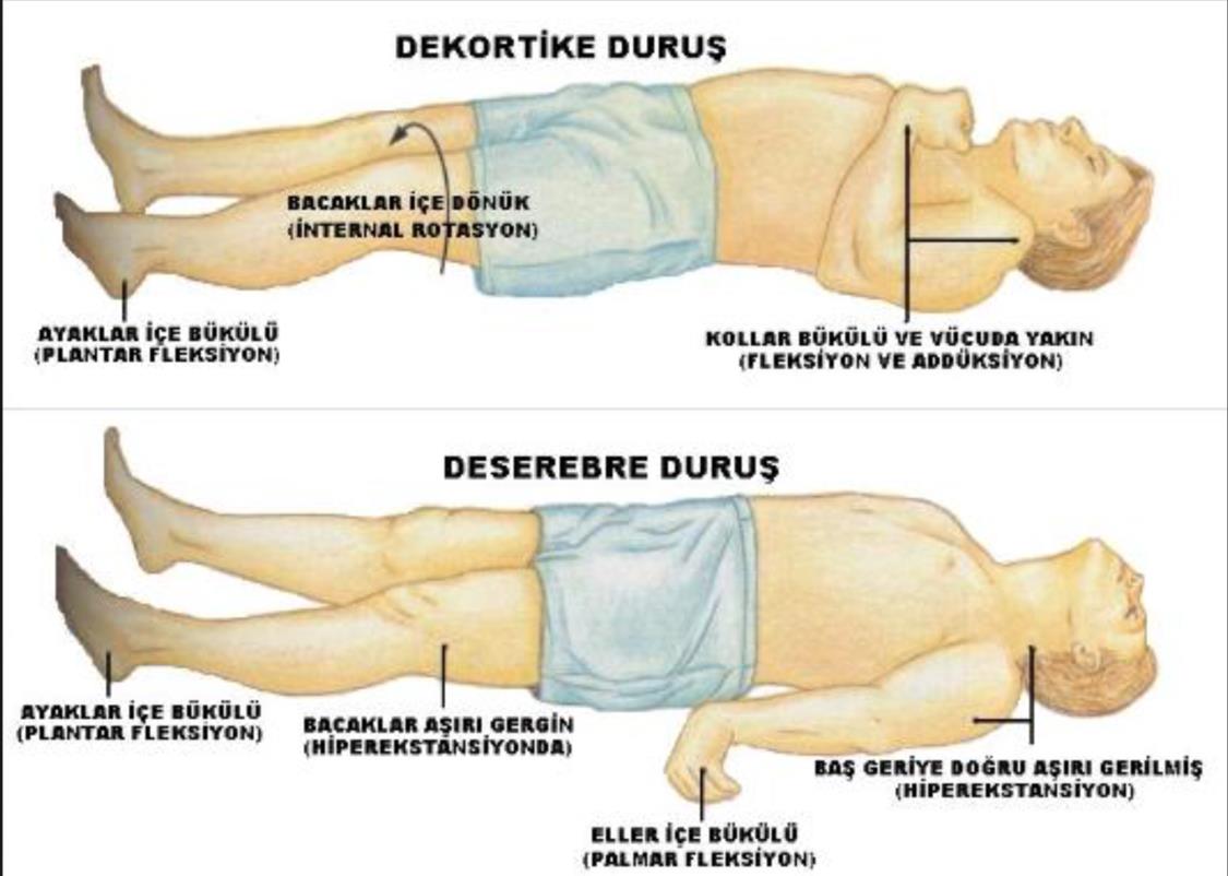 Nörolojik Aciller Ense sertliği bulgusuna 2 yaşından küçük çocuklarda dikkat edilmelidir! Pozitif olmayabilir! Patolojik refleksler : Şekil 11.4.