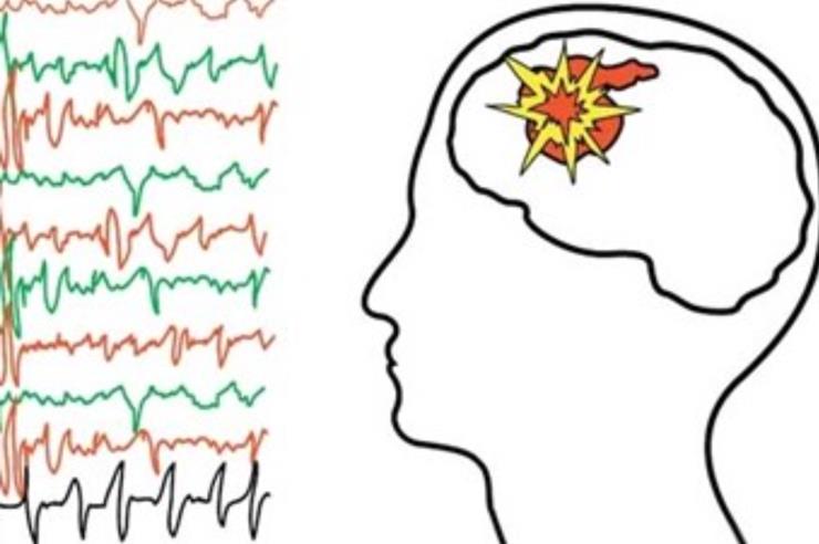 Nörolojik Aciller Epilepsi vakalarının ¾ ünde herhangi bir sebep tespit edilemiyor! Şekil11. 5.