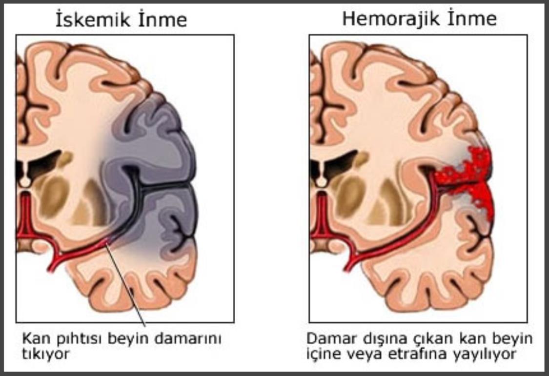 Nörolojik Aciller Hemorajik SVO: Gençlerde daha sık, ölüm oranı daha yüksektir. Şekil11. 6: İskemik ve hemorajik inme Hemorajik SVO nun önemli iki tipi vardır: İntraserebral ve subaraknoid kanama.