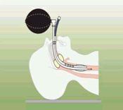 1.3. Solunum Sisteminde Ameliyatlara İlişkin Terimler Cricotracheotomy (krikotrakeotomi): Krikoid kıkırdak aracılığıyla trakeaya kesit yapma, krikoid kıkırdak üzerinden gerçekleştirilen trakeotomi