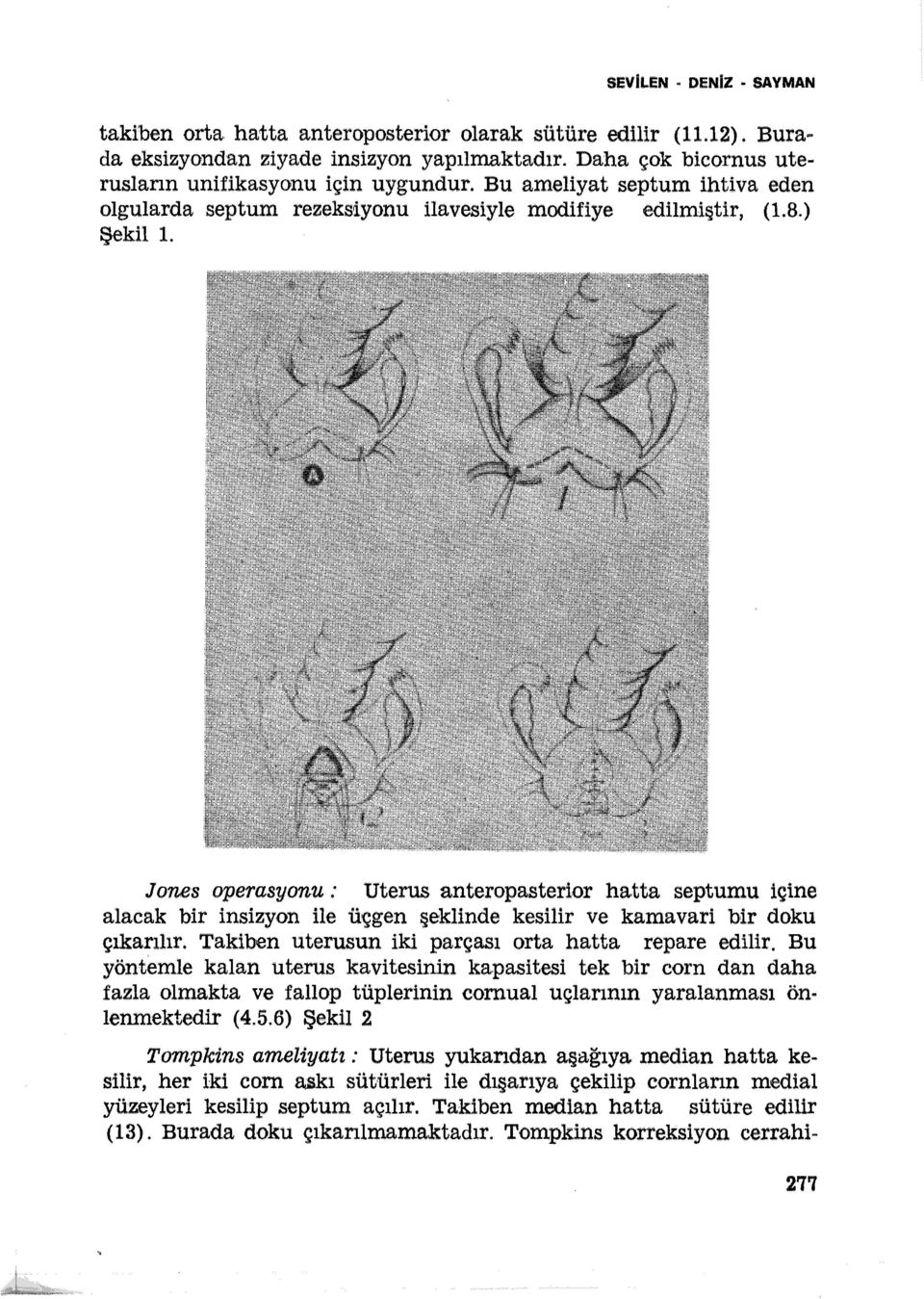 J ones aperasyonu : Uterus anteropasterior hatta septumu içine alacak bir insizyon ile üçgen şeklinde kesilir ve kama vari bir doku çıkarılır. Takiben uterusun iki parçası orta hatta repare edilir.