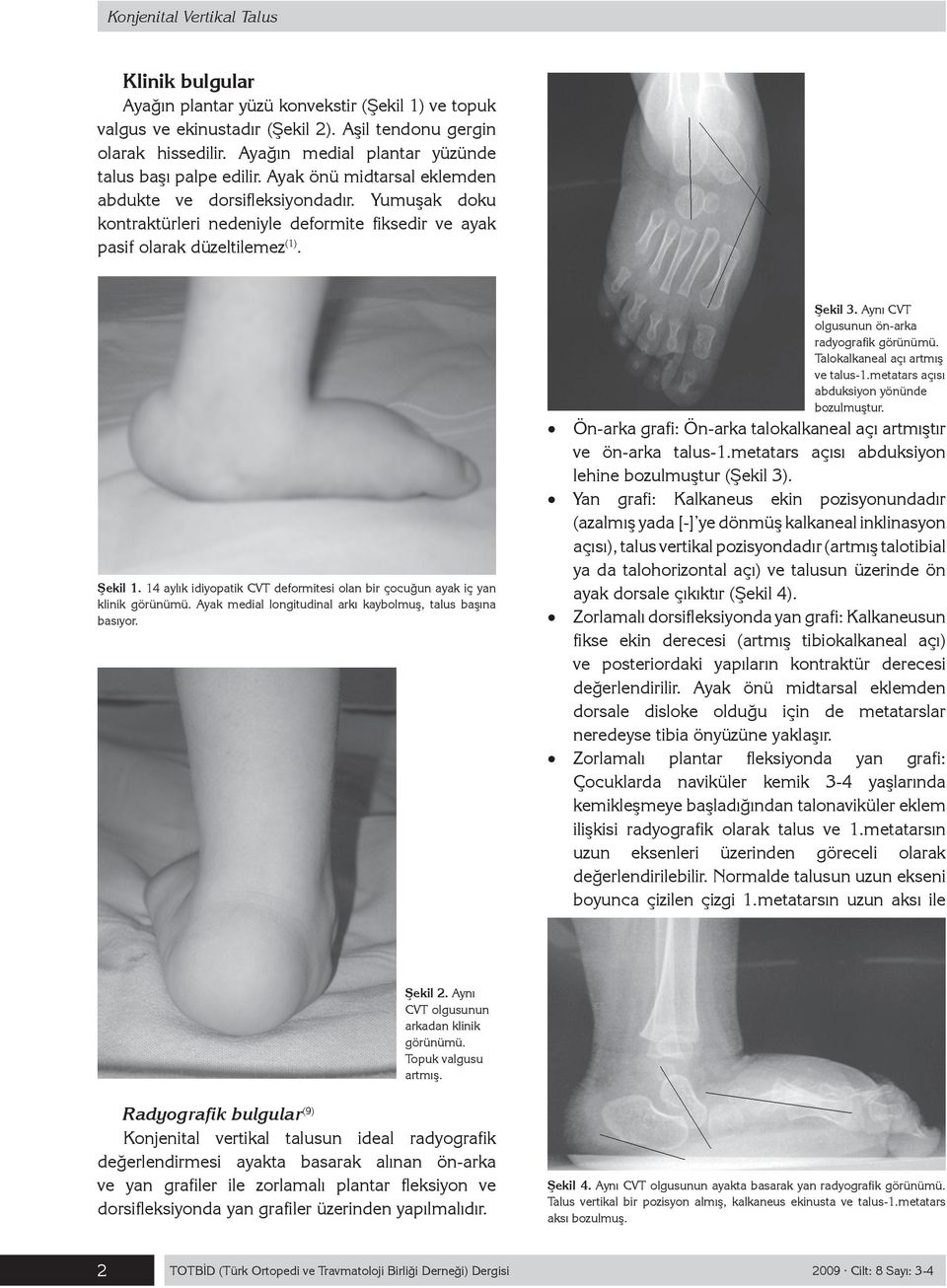 Yumuşak doku kontraktürleri nedeniyle deformite fiksedir ve ayak pasif olarak düzeltilemez (1). Şekil 1. 14 aylık idiyopatik CVT deformitesi olan bir çocuğun ayak iç yan klinik görünümü.