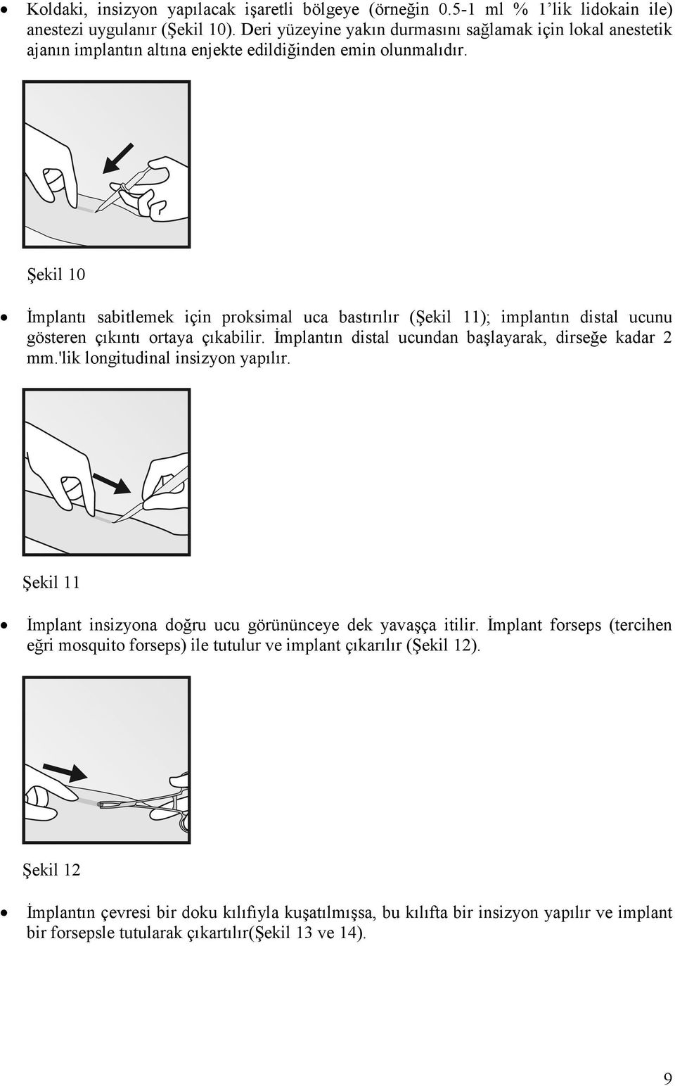 Şekil 10 İmplantı sabitlemek için proksimal uca bastırılır (Şekil 11); implantın distal ucunu gösteren çıkıntı ortaya çıkabilir. İmplantın distal ucundan başlayarak, dirseğe kadar 2 mm.