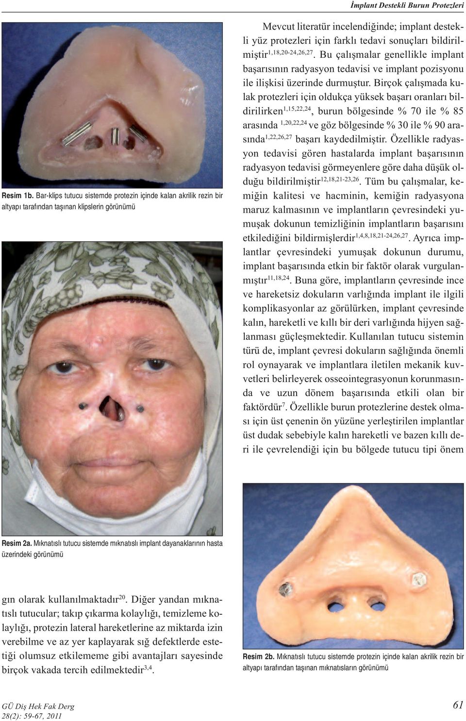 sonuçları bildirilmiştir 1,18,20-24,26,27. Bu çalışmalar genellikle implant başarısının radyasyon tedavisi ve implant pozisyonu ile ilişkisi üzerinde durmuştur.