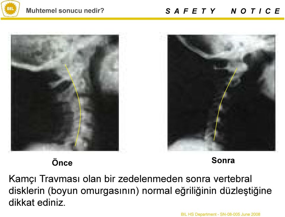 zedelenmeden sonra vertebral disklerin