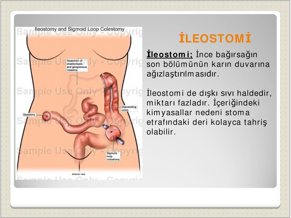 leostomi de d haldedir, miktar fazlad r.