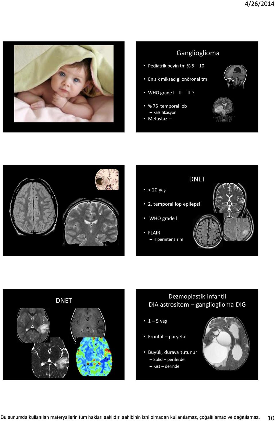 temporal lop epilepsi WHO grade l FLAIR Hiperintens rim DNET Dezmoplastik infantil