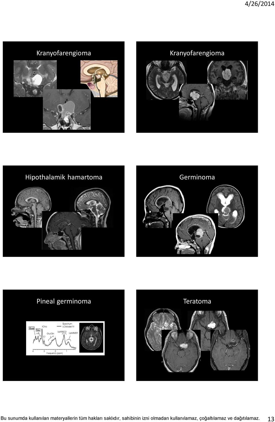 Germinoma Pineal