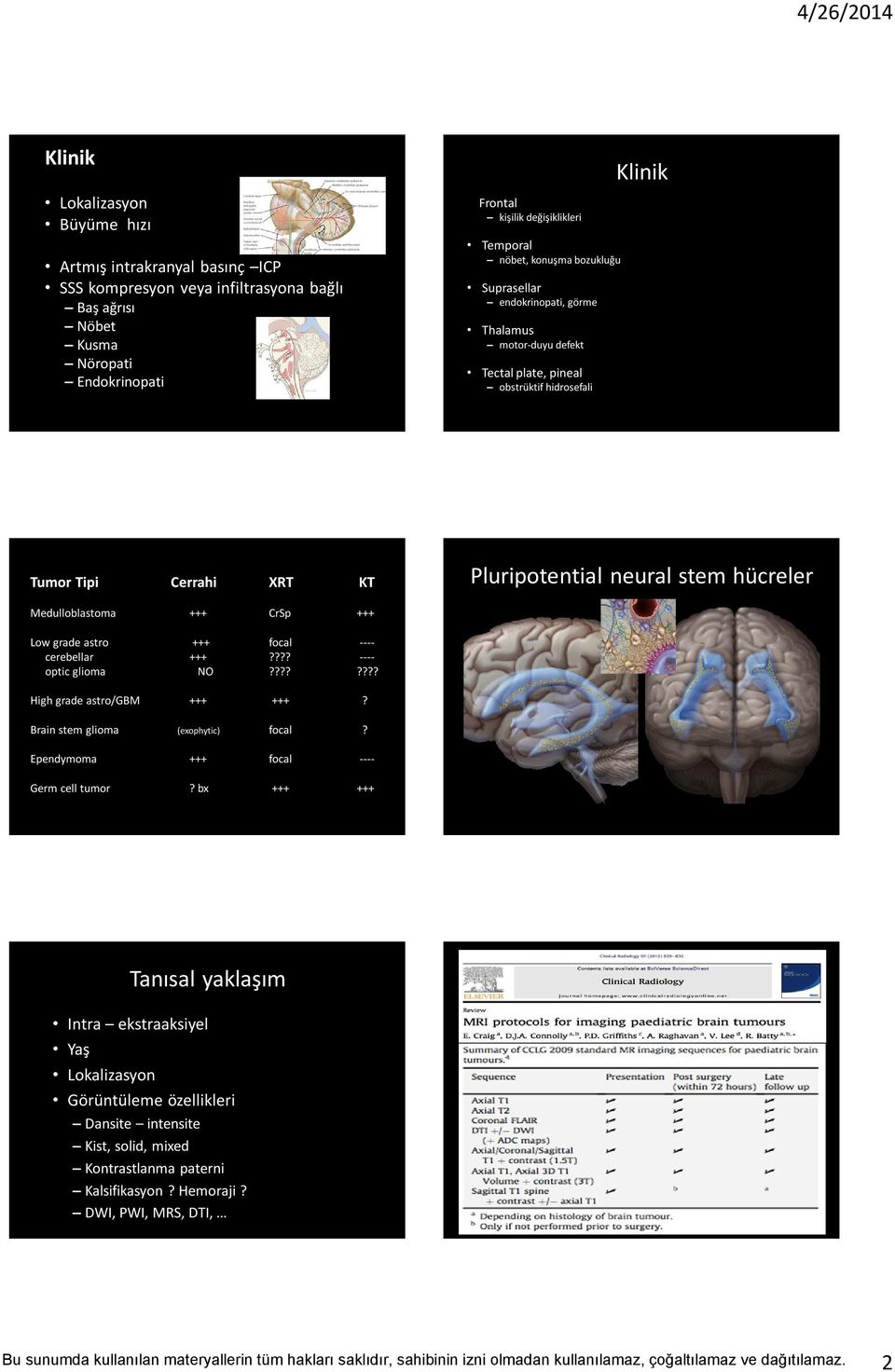 Medulloblastoma +++ CrSp +++ Low grade astro +++ focal ---- cerebellar +++???? ---- optic glioma NO???????? High grade astro/gbm +++ +++? Brain stem glioma (exophytic) focal?