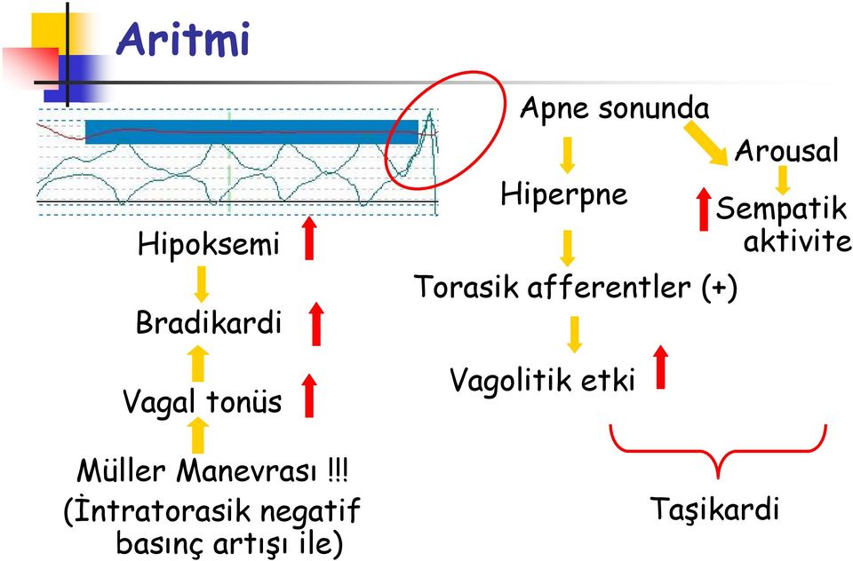 !! (İntratorasik negatif basınç artışı ile) Apne