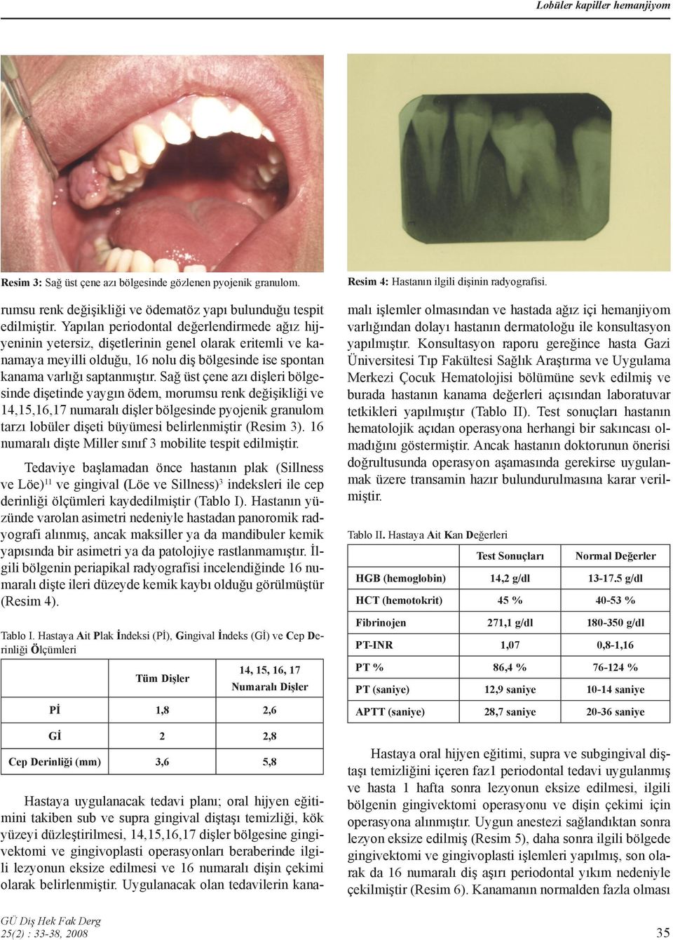 Sağ üst çene azı dişleri bölgesinde dişetinde yaygın ödem, morumsu renk değişikliği ve 14,15,16,17 numaralı dişler bölgesinde pyojenik granulom tarzı lobüler dişeti büyümesi belirlenmiştir (Resim 3).