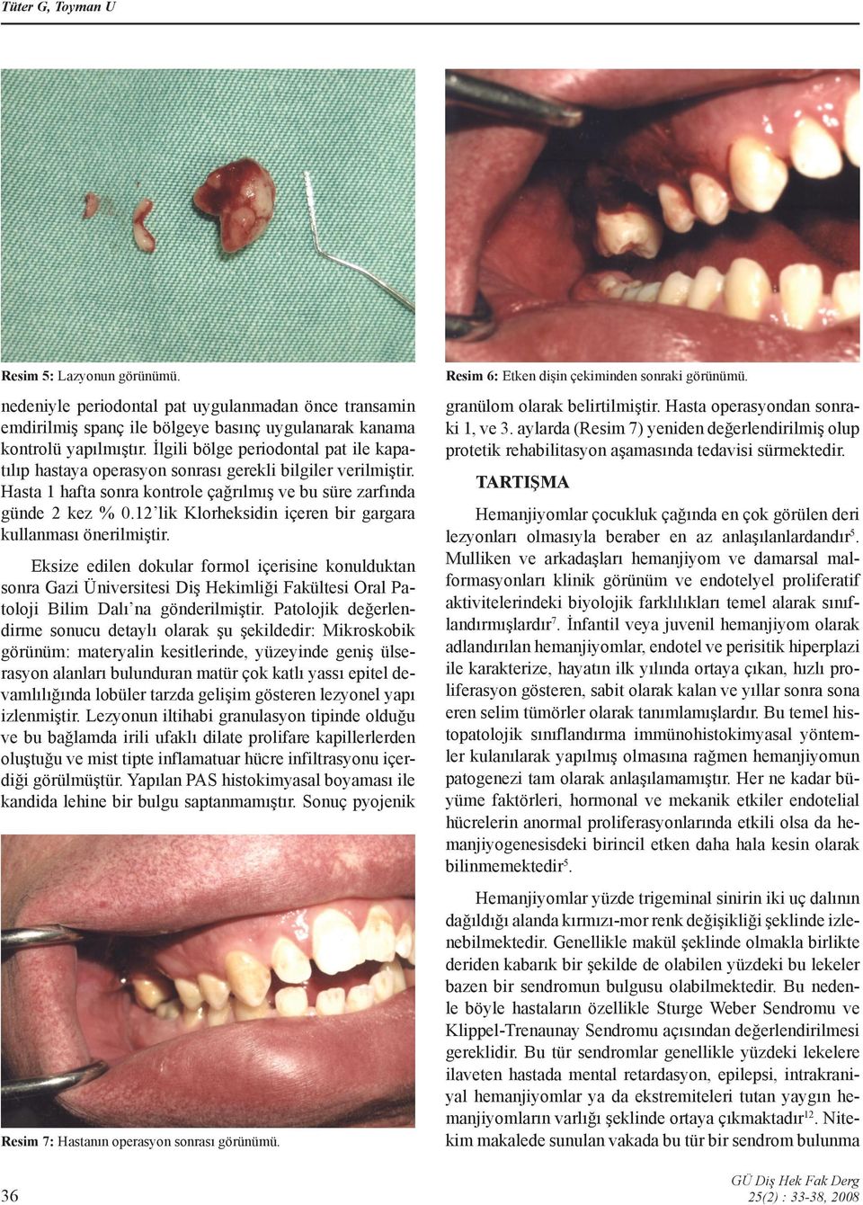 İlgili bölge periodontal pat ile kapatılıp hastaya operasyon sonrası gerekli bilgiler verilmiştir. Hasta 1 hafta sonra kontrole çağrılmış ve bu süre zarfında günde 2 kez % 0.