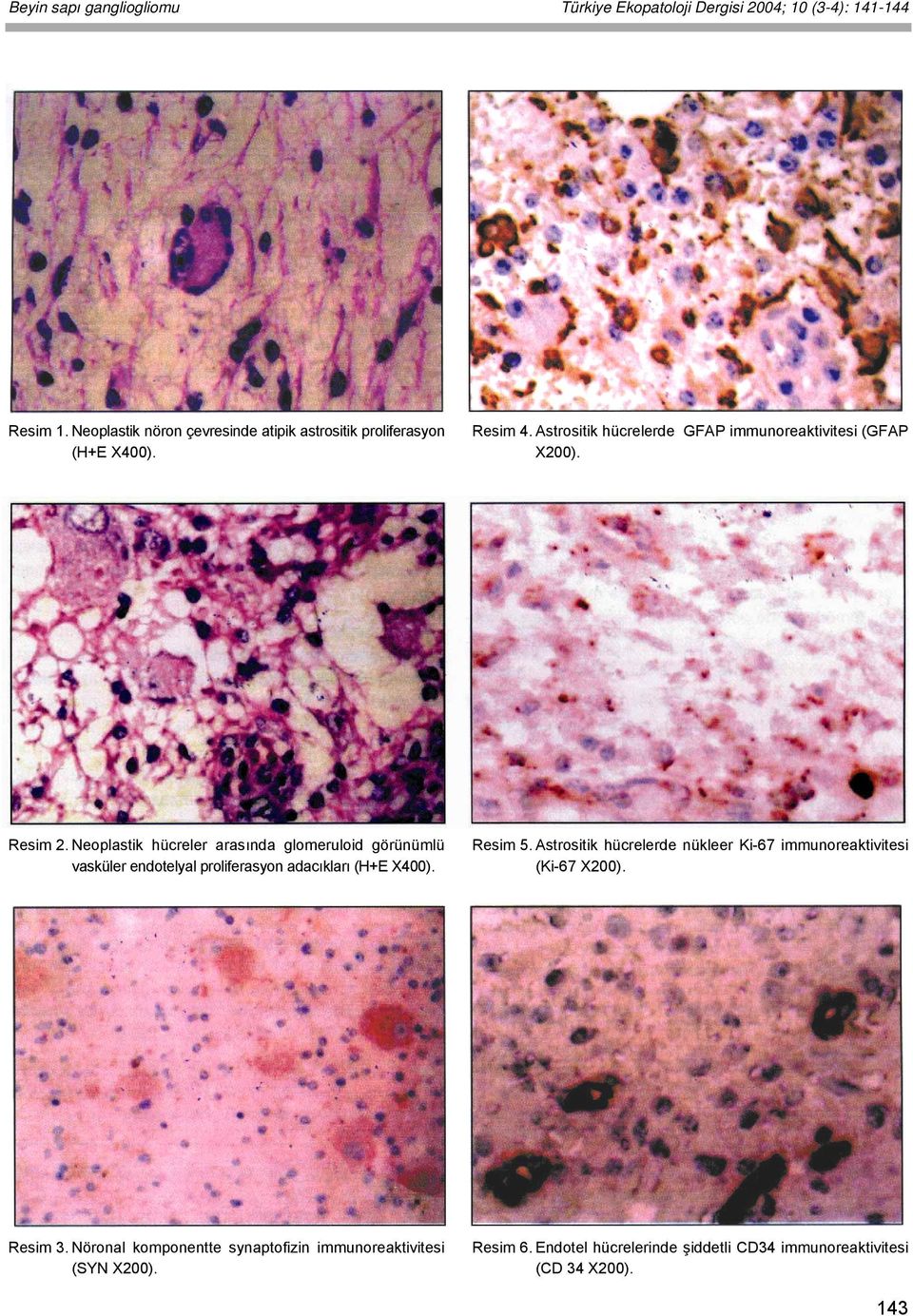 Resim 2. Neoplastik hücreler arasında glomeruloid görünümlü vasküler endotelyal proliferasyon adacıkları (H+E X400). Resim 5.