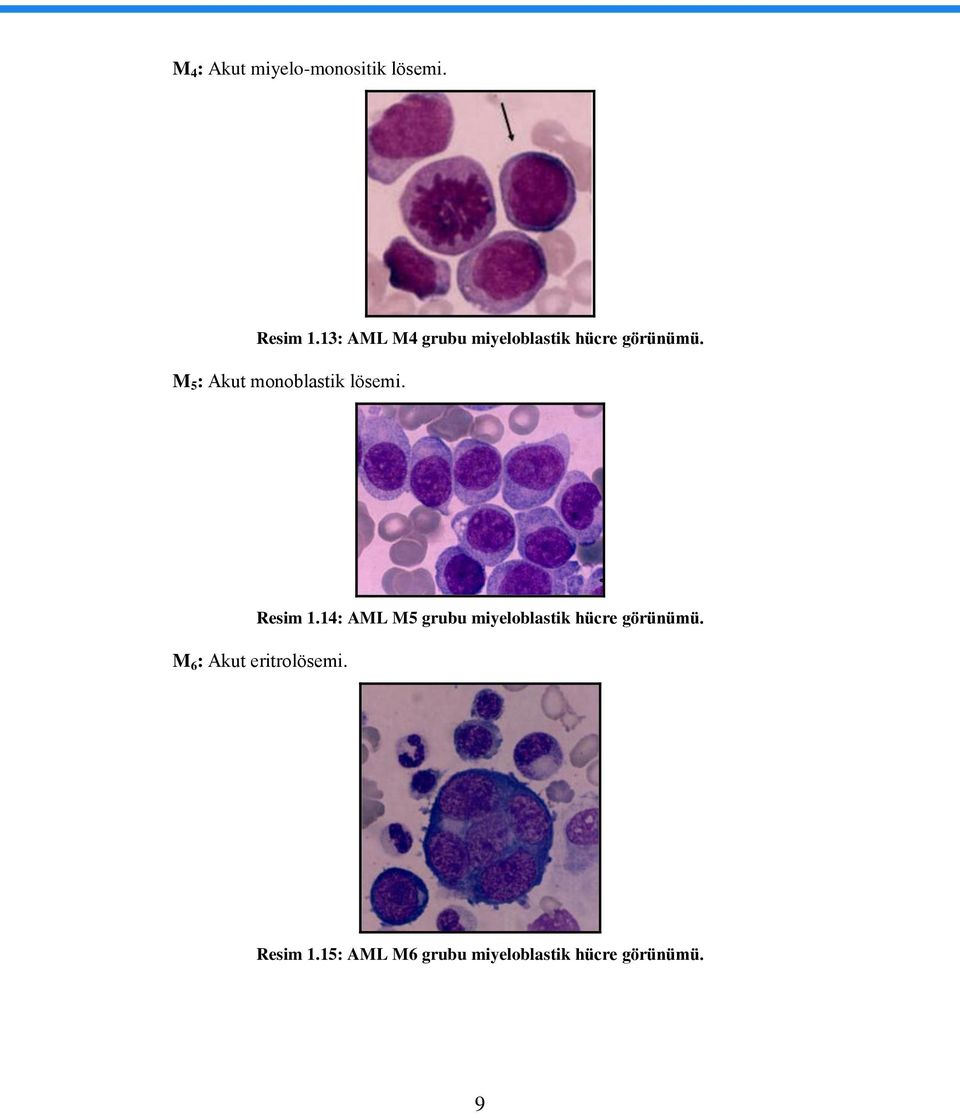M 5 : Akut monoblastik lösemi. Resim 1.