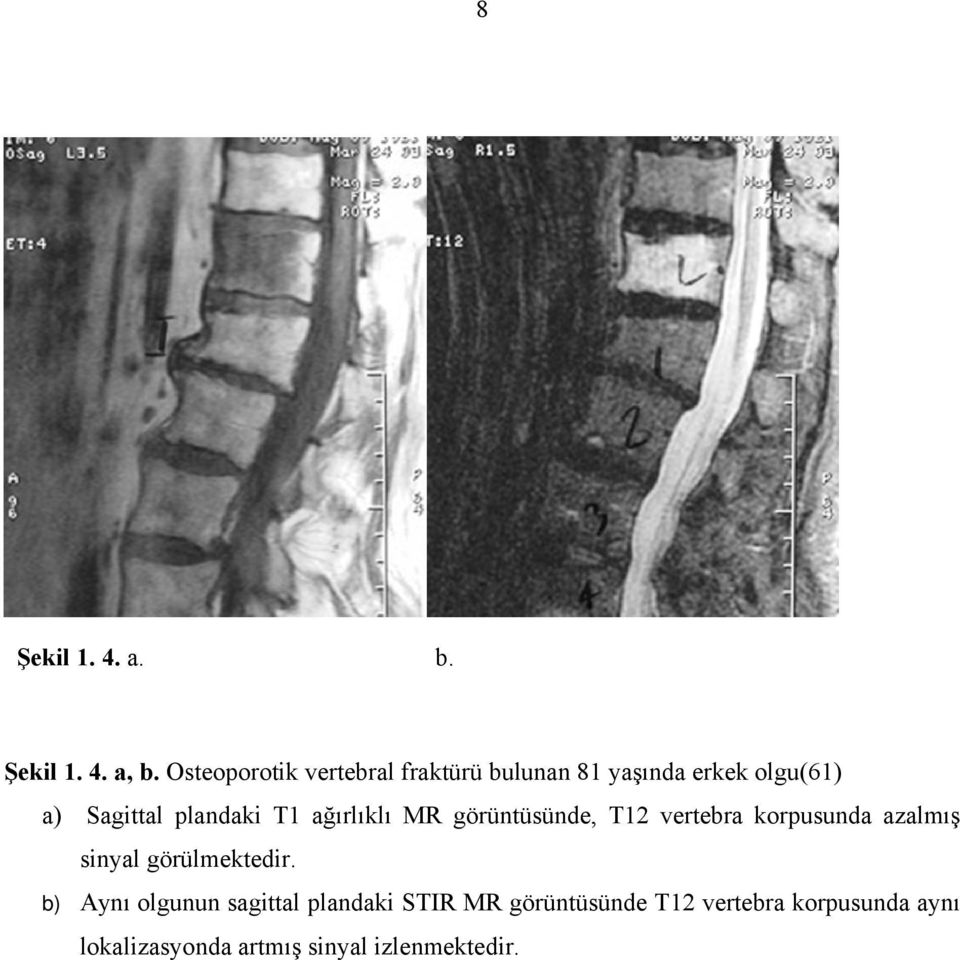 plandaki T1 ağırlıklı MR görüntüsünde, T12 vertebra korpusunda azalmış sinyal