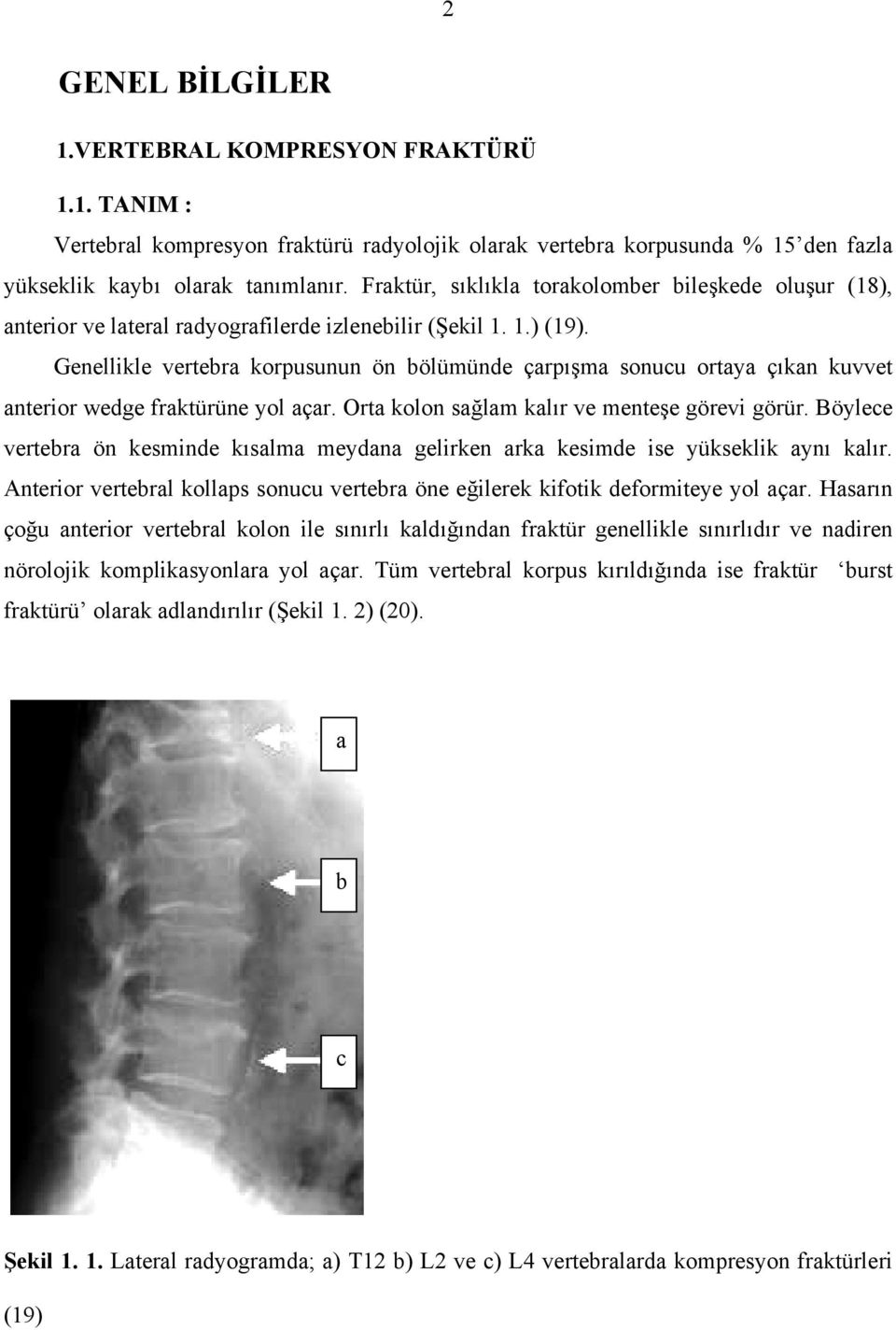 Genellikle vertebra korpusunun ön bölümünde çarpışma sonucu ortaya çıkan kuvvet anterior wedge fraktürüne yol açar. Orta kolon sağlam kalır ve menteşe görevi görür.