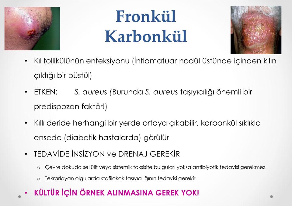 ) Kıllı deride herhangi bir yerde ortaya çıkabilir, karbonkül sıklıkla ensede (diabetik hastalarda) görülür TEDAVİDE İNSİZYON ve