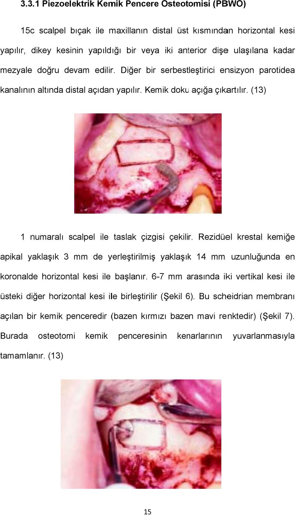 (13) Şekil 6 1 numaralı scalpel ile taslak çizgisi çekilir. Rezidüel krestal kemiğe apikal yaklaşık 3 mm de yerleştirilmiş yaklaşıkk 14 mm uzunluğunda en koronalde horizontal kesi ile başlanır.