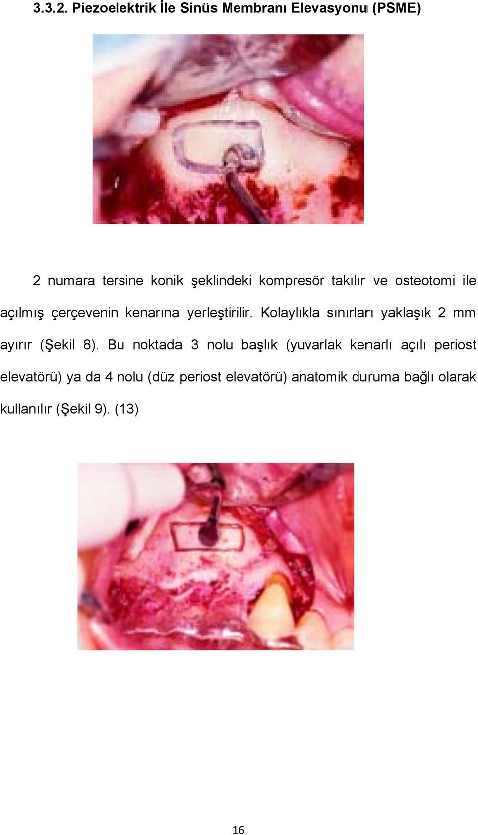 kompresör takılır ve osteotomi ile açılmış çerçevenin kenarına yerleştirilir.