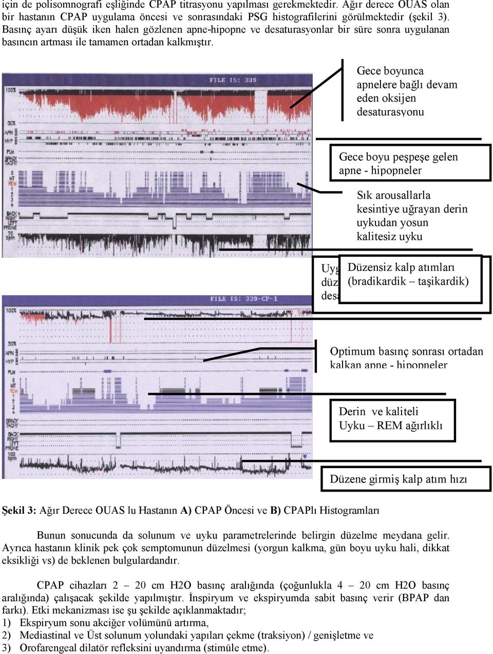 Gece boyunca apnelere bağlı devam eden oksijen desaturasyonu Gece boyu peşpeşe gelen apne - hipopneler Sık arousallarla kesintiye uğrayan derin uykudan yosun kalitesiz uyku Uygulanan Düzensiz Basınç
