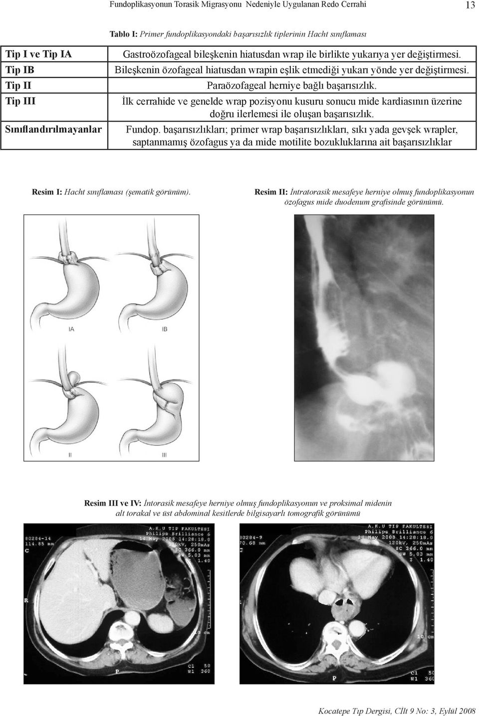 Paraözofageal herniye bağlı başarısızlık. İlk cerrahide ve genelde wrap pozisyonu kusuru sonucu mide kardiasının üzerine doğru ilerlemesi ile oluşan başarısızlık. Fundop.