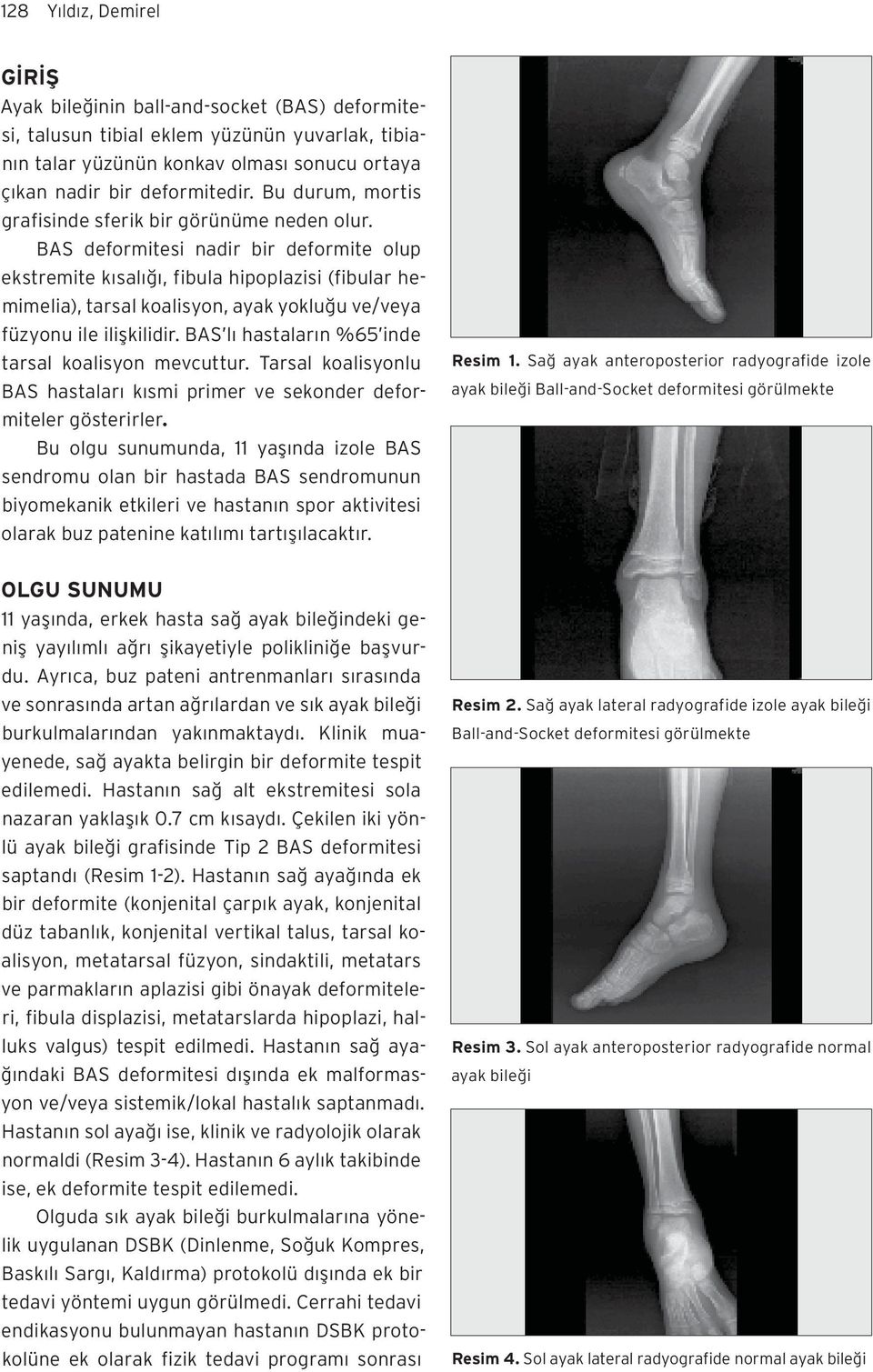 BAS deformitesi nadir bir deformite olup ekstremite kısalığı, fibula hipoplazisi (fibular hemimelia), tarsal koalisyon, ayak yokluğu ve/veya füzyonu ile ilişkilidir.