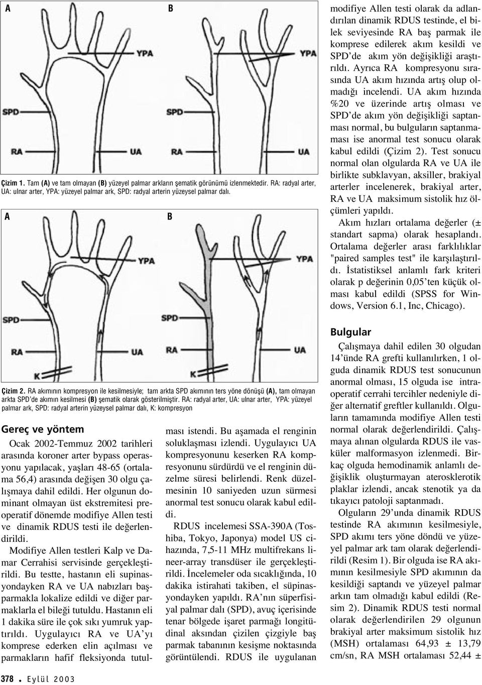 RA: radyal arter, UA: ulnar arter, YPA: yüzeyel palmar ark, SPD: radyal arterin yüzeysel palmar dal, K: kompresyon Gereç ve yöntem Ocak 2002-Temmuz 2002 tarihleri aras nda koroner arter bypass