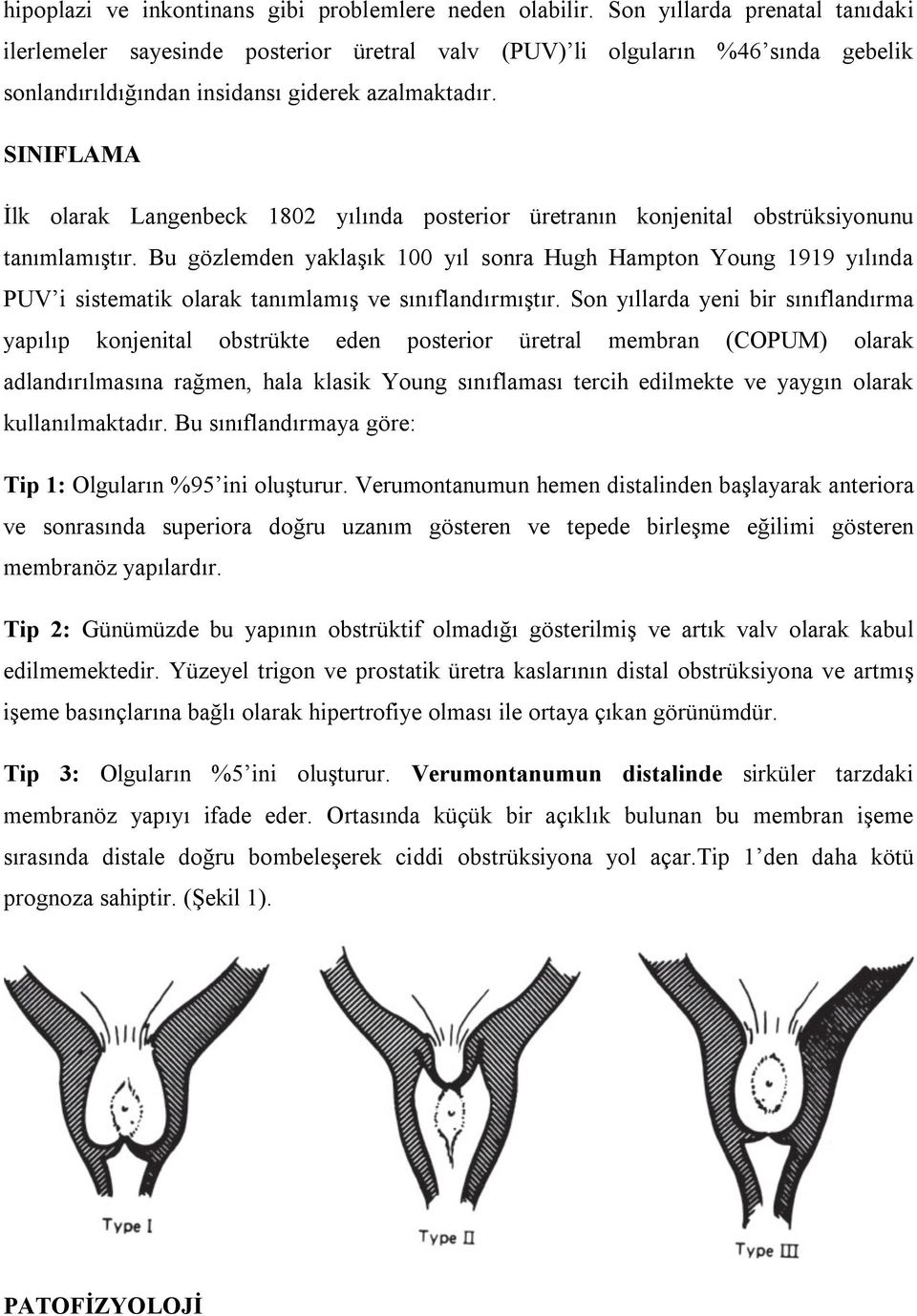 SINIFLAMA İlk olarak Langenbeck 1802 yılında posterior üretranın konjenital obstrüksiyonunu tanımlamıştır.