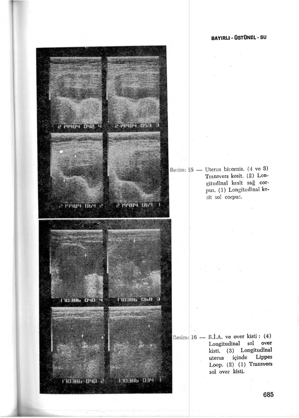 Re'sim: 16 - R.i.A. ve over kisti: (4) Longitudinal sol over kisti.