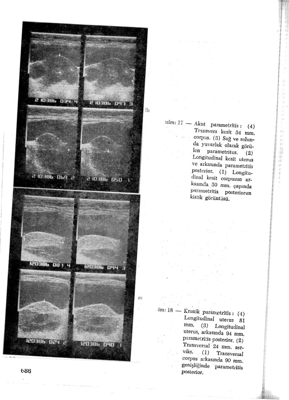 çapında para:metritis posıteriorull kisti:k görüntüsü. tı86. esim: 18 -- Kronik paran1ıatrltis: (4) Longitudinal uterus 81 nun.