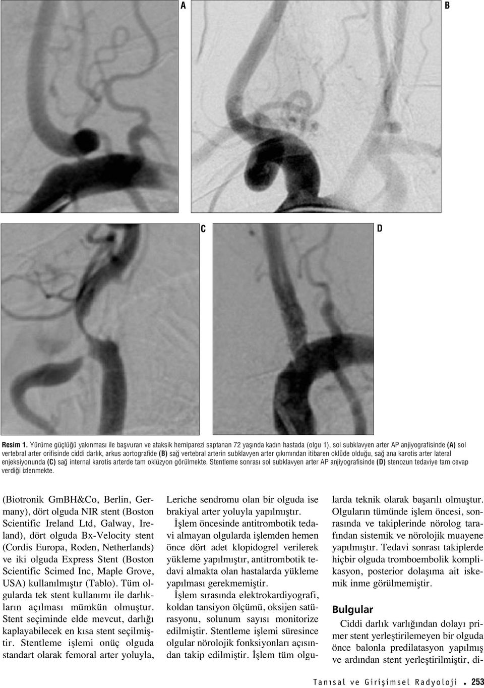 arkus aortografide (B) sa vertebral arterin subklavyen arter ç k m ndan itibaren oklüde oldu u, sa ana karotis arter lateral enjeksiyonunda (C) sa internal karotis arterde tam oklüzyon görülmekte.