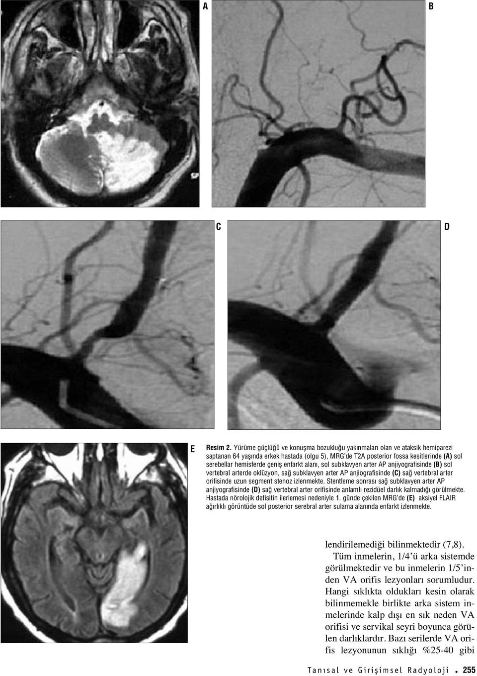 enfarkt alan, sol subklavyen arter AP anjiyografisinde (B) sol vertebral arterde oklüzyon, sa subklavyen arter AP anjiografisinde (C) sa vertebral arter orifisinde uzun segment stenoz izlenmekte.