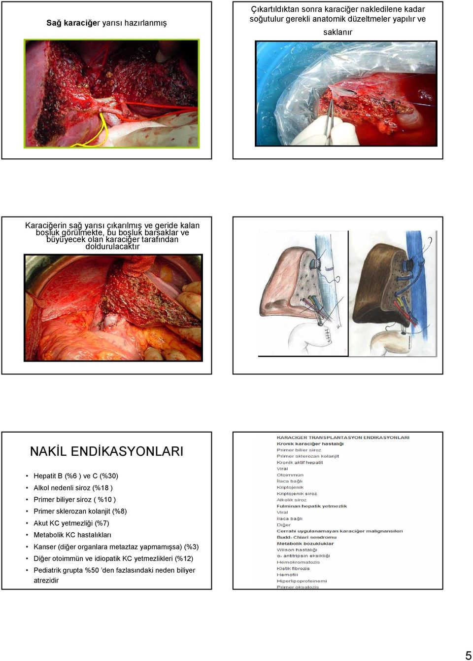 (%6 ) ve C (%30) Alkol nedenli siroz (%18 ) Primer biliyer siroz ( %10 ) Primer sklerozan kolanjit (%8) Akut KC yetmezliği (%7) Metabolik KC hastalıkları